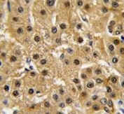 IHC analysis of FFPE human hepatocarcinoma tissue stained with c-Abl antibody