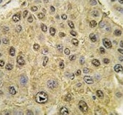 IHC analysis of FFPE human hepatocarcinoma tissue stained with HIF-1 alpha antibody