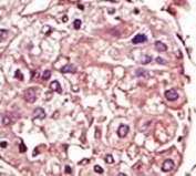 IHC analysis of FFPE human hepatocarcinoma tissue stained with the TGF Beta Receptor antibody