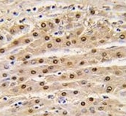 IHC analysis of FFPE human hepatocarcinoma tissue stained with anti-GAPDH antibody
