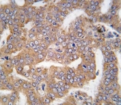IHC analysis of FFPE human prostate carcinoma tissue stained with PAK4 antibody