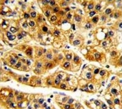 IHC analysis of FFPE human hepatocarcinoma with IkB alpha antibody