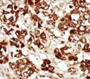 IHC analysis of FFPE human hepatocarcinoma tissue stained with the ZAK antibody