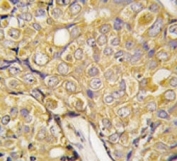 IHC analysis of FFPE human prostate carcinoma tissue stained with TRPM8 antibody