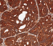 IHC testing of FFPE human colon carcinoma tissue with DUSP6 antibody. HIER: steam section in pH9 EDTA for 20 min and allow to cool prior to staining.