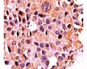 IHC analysis of FFPE human breast carcinoma tissue stained with the Calcineurin antibody