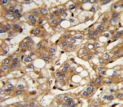 IHC analysis of FFPE human hepatocarcinoma with IFNB1 antibody