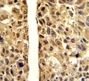 IHC analysis of FFPE human hepatocarcinoma stained with ARG1 antibody