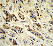 IHC analysis of FFPE human breast carcinoma stained with IL-10 antibody