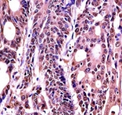 Anti-HMGB1 antibody immunohistochemistry analysis in formalin fixed and paraffin embedded human colon carcinoma.