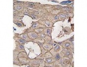 IHC testing of FFPE human lung carcinoma tissue with Annexin A2 antibody. HIER: steam section in pH6 citrate buffer for 20 min and allow to cool prior to staining.