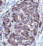 IHC testing of FFPE human colon carcinoma tissue with IRF7 antibody. HIER: steam section in pH6 citrate buffer for 20 min and allow to cool prior to staining.