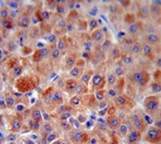 IHC testing of FFPE human hepatocellular carcinoma tissue with Complement factor H antibody. HIER: steam section in pH6 citrate buffer for 20 min and allow to cool prior to staining.