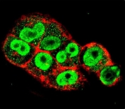 Immunofluorescent staining of fixed and permeabilized human A2058 cells with TIMP-1 antibody (green) and anti-Actin (red).