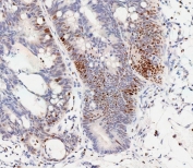 IHC testing of FFPE human colon carcinoma tissue with phospho-CREB antibody antibody. HIER: steam section in pH9 EDTA for 20 min and allow to cool prior to staining.