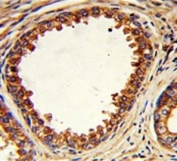 IHC testing of FFPE human prostate carcinoma tissue with PTP4A2 antibody. HIER: steam section in pH6 citrate buffer for 20 min and allow to cool prior to staining.