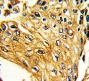 IHC testing of FFPE human lung carcinoma tissue with IFNGR2 antibody. HIER: steam section in pH6 citrate buffer for 20 min and allow to cool prior to staining.