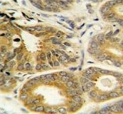IHC testing of FFPE human prostate carcinoma tissue with ARL8A antibody. HIER: steam section in pH6 citrate buffer for 20 min and allow to cool prior to staining.