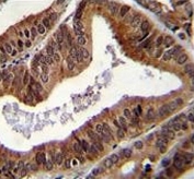 IHC testing of FFPE human prostate carcinoma tissue with Tyrosyl-DNA phosphodiesterase 2 antibody. HIER: steam section in pH6 citrate buffer for 20 min and allow to cool prior to staining.