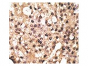 IHC testing of FFPE human breast cancer tissue with ATG4B antibody. HIER: steam section in pH6 citrate buffer for 20 min and allow to cool prior to staining.