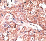 IHC testing of FFPE human cancer tissue with ATG4B antibody. HIER: steam section in pH6 citrate buffer for 20 min and allow to cool prior to staining.