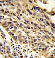IHC testing of FFPE human lung carcinoma tissue with TRIP13 antibody. HIER: steam section in pH6 citrate buffer for 20 min and allow to cool prior to staining.