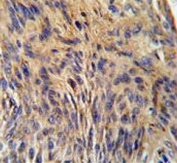 IHC testing of FFPE human lung carcinoma tissue with HSPA5 antibody. HIER: steam section in pH6 citrate buffer for 20 min and allow to cool prior to staining.