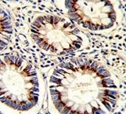 IHC testing of FFPE human colon carcinoma tissue with TYSY antibody. HIER: steam section in pH6 citrate buffer for 20 min and allow to cool prior to staining.