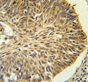 IHC testing of FFPE human lung carcinoma tissue with LRG1 antibody. HIER: steam section in pH6 citrate buffer for 20 min and allow to cool prior to staining.