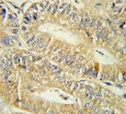 IHC testing of FFPE human colon carcinoma tissue with IRF7 antibody. HIER: steam section in pH6 citrate buffer for 20 min and allow to cool prior to staining.