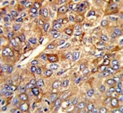 IHC testing of FFPE human hepatocellular carcinoma tissue with Ferritin heavy chain antibody. HIER: steam section in pH6 citrate buffer for 20 min and allow to cool prior to staining.