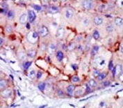 IHC testing of FFPE human cancer tissue with CAMK1 delta antibody. HIER: steam section in pH6 citrate buffer for 20 min and allow to cool prior to staining.