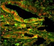 Immunofluorescent staining of FFPE human prostate carcinoma with CAPZA1 antibody (green) and propidium iodide (red).