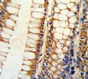 IHC testing of FFPE human colon carcinoma tissue with Bcl-2-like protein 11 antibody. HIER: steam section in pH6 citrate buffer for 20 min and allow to cool prior to staining.