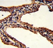 IHC testing of FFPE human prostate carcinoma tissue with PSMB9 antibody. HIER: steam section in pH6 citrate buffer for 20 min and allow to cool prior to staining.