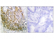 IHC staining of FFPE human lung carcinoma tissue with MMP10 antibody (left) and without primary antibody (right). HIER: steam section in pH6 citrate buffer for 20 min and allow to cool prior to staining.