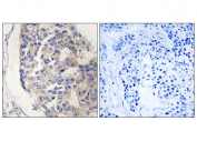 IHC staining of FFPE human breast carcinoma tissue with C1S antibody (left) and without primary antibody (right). HIER: steam section in pH6 citrate buffer for 20 min and allow to cool prior to staining.