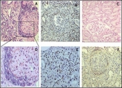 ISH and IMH demonstrating gremlin mRNA and gremlin protein in crescentic PECs and tubular epithelial cells of patients with pauci-immune crescentic GN. In comparison with normal renal tissue in which there is no expression of gremlin mRNA (C), proliferating PECs of glomerular crescents show a strong expression of gremlin mRNA by ISH (A); and gremlin protein expression by IMH (B); immune competent infiltrating interstitial cells are also strongly positive for gremlin staining (E); and CTGF was also expressed in these glomerular crescentic cells (F).