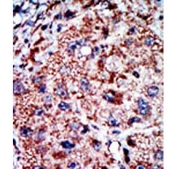 IHC staining of FFPE human cancer tissue with PFKL antibody. HIER: steam section in pH6 citrate buffer for 20 min and allow to cool prior to staining.