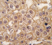 IHC staining of FFPE human hepatocarcinoma tissue with B2AR antibody. HIER: steam section in pH6 citrate buffer for 20 min and allow to cool prior to staining.