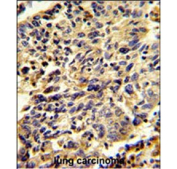 IHC staining of FFPE human lung carcinoma tissue with Glypican-1 antibody. HIER: steam section in pH6 citrate buffer for 20 min and allow to cool prior to staining.