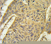 IHC staining of FFPE human lung carcinoma tissue with AGER antibody. HIER: steam section in pH6 citrate buffer for 20 min and allow to cool prior to staining.