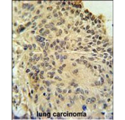 IHC staining of FFPE human lung carcinoma tissue with RSPO2 antibody. HIER: steam section in pH6 citrate buffer for 20 min and allow to cool prior to staining.