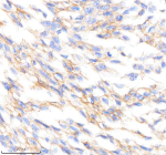IHC analysis of PTPRR using anti-PTPRR antibody. PTPRR was detected in a paraffin-embedded section of human ovarian cancer tissue. Heat mediated antigen retrieval was performed in EDTA buffer (pH 8.0, epitope retrieval solution). The tissue section was blocked with 10% goat serum. The tissue section was then incubated with 2 ug/ml rabbit anti-PTPRR antibody overnight at 4oC. Peroxidase Conjugated Goat Anti-rabbit IgG was used as secondary antibody and incubated for 30 minutes at 37oC. The tissue section was developed using an HRP secondary and DAB substrate.