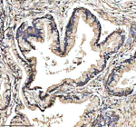 IHC analysis of GHRHR using anti-GHRHR antibody. GHRHR was detected in a paraffin-embedded section of human prostate cancer tissue. Heat mediated antigen retrieval was performed in EDTA buffer (pH 8.0, epitope retrieval solution). The tissue section was blocked with 10% goat serum. The tissue section was then incubated with 2 ug/ml rabbit anti-GHRHR antibody overnight at 4oC. Peroxidase Conjugated Goat Anti-rabbit IgG was used as secondary antibody and incubated for 30 minutes at 37oC. The tissue section was developed using an HRP secondary and DAB substrate.