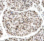 IHC analysis of Histone H3 (acetyl K14) using anti-Histone H3 (acetyl K14) antibody. Histone H3 (acetyl K14) was detected in a paraffin-embedded section of human liver cancer tissue. Heat mediated antigen retrieval was performed in EDTA buffer (pH 8.0, epitope retrieval solution). The tissue section was blocked with 10% goat serum. The tissue section was then incubated with a dilution of 1:50 rabbit anti-Histone H3 (acetyl K14) antibody overnight at 4oC. Peroxidase Conjugated Goat Anti-rabbit IgG was used as secondary antibody and incubated for 30 minutes at 37oC. The tissue section was developed using an HRP secondary and DAB substrate.