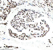 IHC analysis of Histone H3 (acetyl K14) using anti-Histone H3 (acetyl K14) antibody. Histone H3 (acetyl K14) was detected in a paraffin-embedded section of human lung cancer tissue. Heat mediated antigen retrieval was performed in EDTA buffer (pH 8.0, epitope retrieval solution). The tissue section was blocked with 10% goat serum. The tissue section was then incubated with a dilution of 1:50 rabbit anti-Histone H3 (acetyl K14) antibody overnight at 4oC. Peroxidase Conjugated Goat Anti-rabbit IgG was used as secondary antibody and incubated for 30 minutes at 37oC. The tissue section was developed using an HRP secondary and DAB substrate.