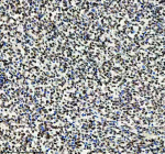 IHC analysis of Histone H3 (acetyl K14) using anti-Histone H3 (acetyl K14) antibody. Histone H3 (acetyl K14) was detected in a paraffin-embedded section of human lymphoma tissue. Heat mediated antigen retrieval was performed in EDTA buffer (pH 8.0, epitope retrieval solution). The tissue section was blocked with 10% goat serum. The tissue section was then incubated with a dilution of 1:50 rabbit anti-Histone H3 (acetyl K14) antibody overnight at 4oC. Peroxidase Conjugated Goat Anti-rabbit IgG was used as secondary antibody and incubated for 30 minutes at 37oC. The tissue section was developed using an HRP secondary and DAB substrate.