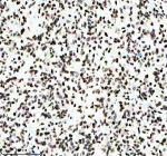 IHC analysis of Histone H3 (acetyl K14) using anti-Histone H3 (acetyl K14) antibody. Histone H3 (acetyl K14) was detected in a paraffin-embedded section of human glioma tissue. Heat mediated antigen retrieval was performed in EDTA buffer (pH 8.0, epitope retrieval solution). The tissue section was blocked with 10% goat serum. The tissue section was then incubated with a dilution of 1:50 rabbit anti-Histone H3 (acetyl K14) antibody overnight at 4oC. Peroxidase Conjugated Goat Anti-rabbit IgG was used as secondary antibody and incubated for 30 minutes at 37oC. The tissue section was developed using an HRP secondary and DAB substrate.