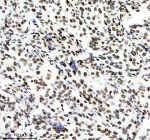 IHC analysis of Histone H3 (acetyl K14) using anti-Histone H3 (acetyl K14) antibody. Histone H3 (acetyl K14) was detected in a paraffin-embedded section of human ovarian cancer tissue. Heat mediated antigen retrieval was performed in EDTA buffer (pH 8.0, epitope retrieval solution). The tissue section was blocked with 10% goat serum. The tissue section was then incubated with a dilution of 1:50 rabbit anti-Histone H3 (acetyl K14) antibody overnight at 4oC. Peroxidase Conjugated Goat Anti-rabbit IgG was used as secondary antibody and incubated for 30 minutes at 37oC. The tissue section was developed using an HRP secondary and DAB substrate.